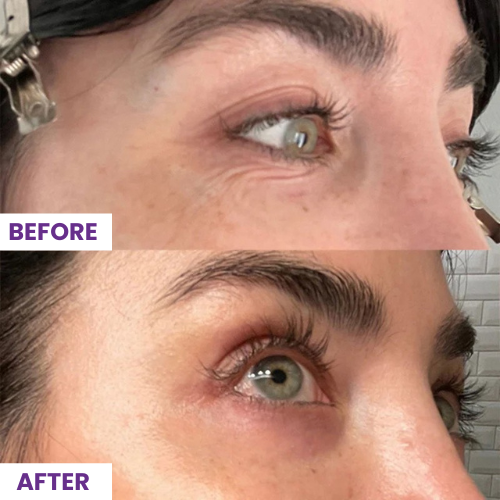 Noîr™ Wrinkle Smoothing Facial Patches