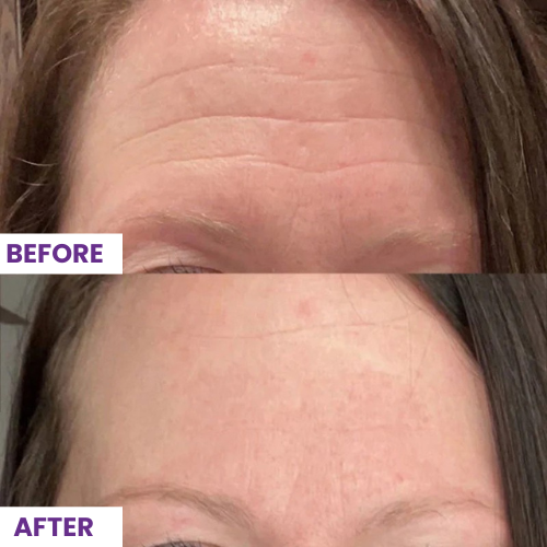 Noîr™ Wrinkle Smoothing Facial Patches